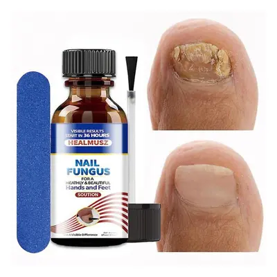 Rep Serum Anti- Anti Paronya Onychocosis Paronya Feet Care