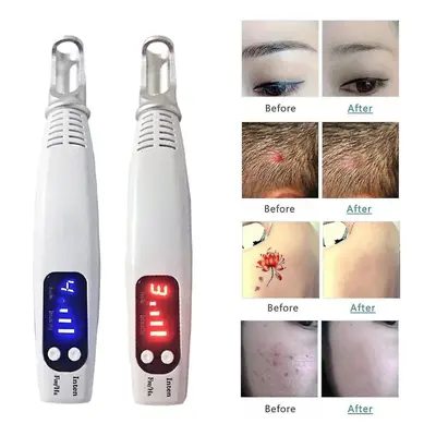 Home Portable Picosecond Tattoo Removal Pen Fit For Mole Dark Spot Acne Scar -ys