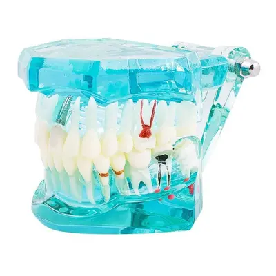 (blue) Dental Study Tooth Transparent Adult Pathological Teeth Model