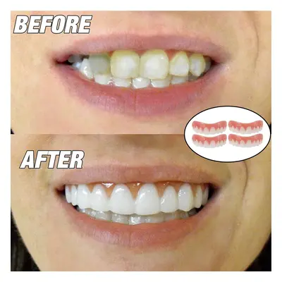 Teeth Veneers Denture Teeth Whitening Braces Toy Fake Tooth Cover Beauty