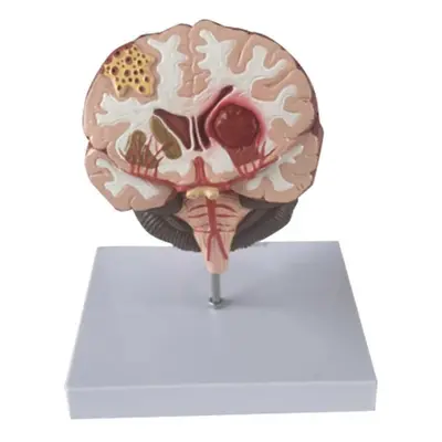 Human Brain Disease Model - Brain Pathology Brainstem Hemorrhage Medical Teaching Model - Human 