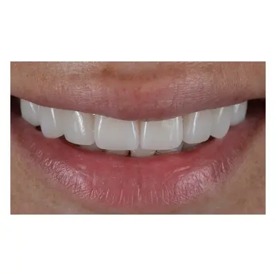 Eight Teeth Composite Bonding with Whitening