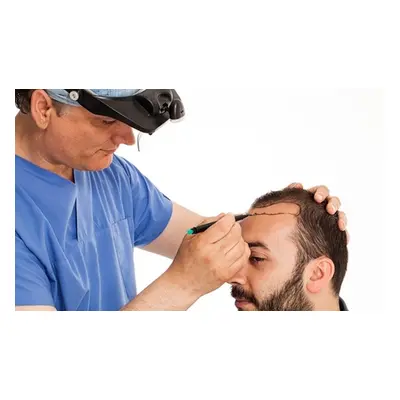 Scalp micropigmentation treatment with consultation