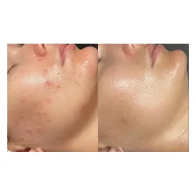 One session of microneedling