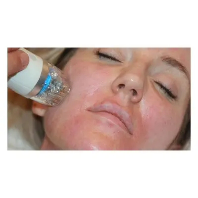 Microneedling with RF (Stretch Marks) and using Hyaluronic Acid. Single Session