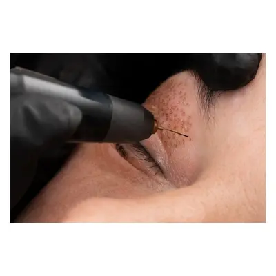 Fibroblast skin tightening treatment on one area