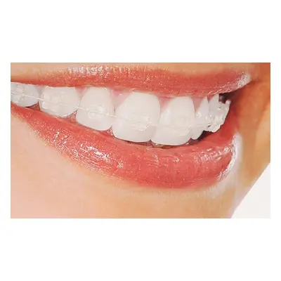 Orthodontic Metal Braces Upper & Lower Teeth