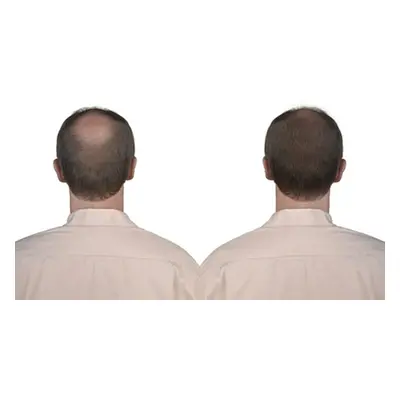 Platelet-Rich-Plasma Hairloss Treatment