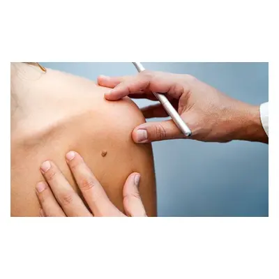 On one area, mole wart milia or skin tag removal