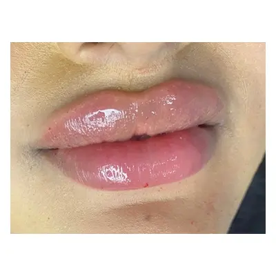 0.5 ml Dermal Lip Filler Treatment