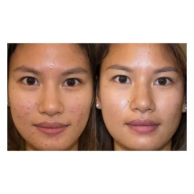 Acne Facial Reduces Breakouts Clear Bacteria Skin Treatment - 6 Sessions