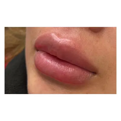 1ml lip dermal filler