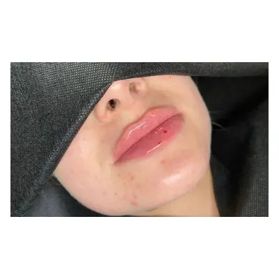 0.5 mL Russian Dermal Lip Filler; New Customers Only