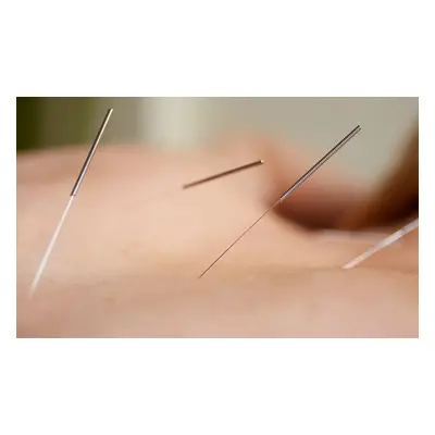 Two treatments, acupuncture or cupping with a consultation