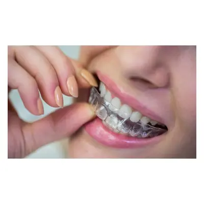 Clear Braces For One Arch