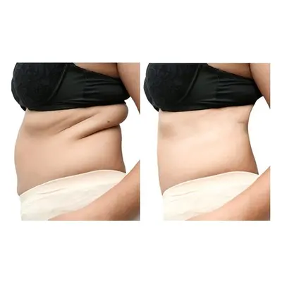 Body Contouring with Ultrasound Cavitation & RF & Skin Tightening