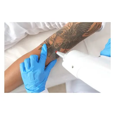 Three sessions of laser tattoo removal