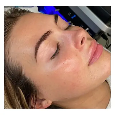 HydraFacial 6in1 treatment