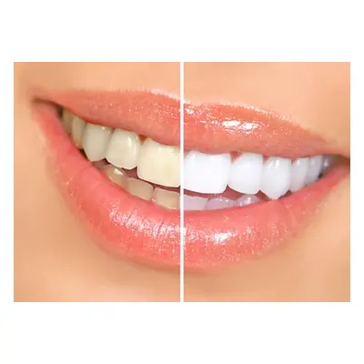 LED Brighten Up Teeth Whitening Kit