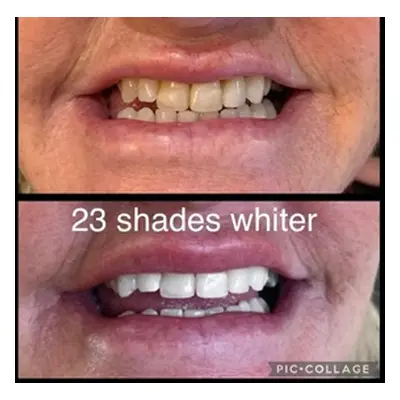 One Laser Teeth Whitening Treatment (Natura White)