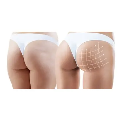 6 sessions 60-Minute Body Contouring & Brazilian Booty Lift and Consultation