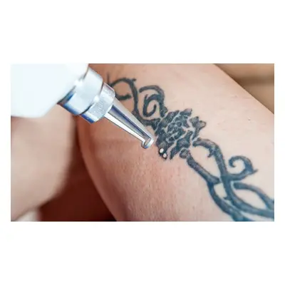 Up to 5cm x 5cm area, three laser tattoo removal sessions