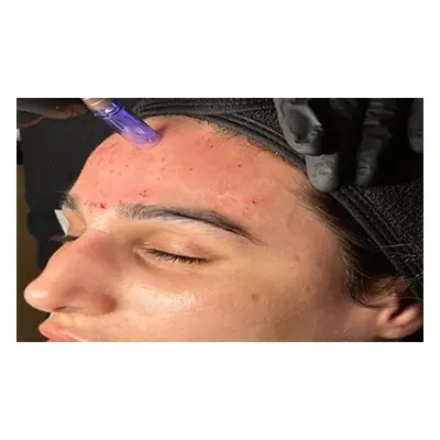 Luxury London Microneedling Treatment Plus using Derma-Quest product & LED light