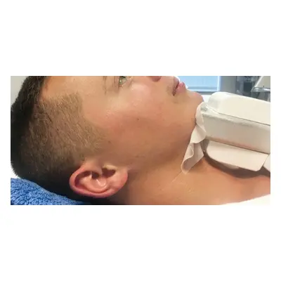 Cryo Freeze Chin Reduction