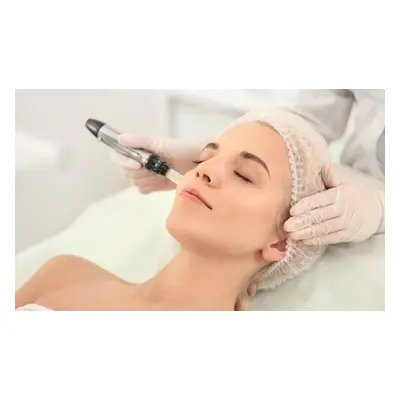 RF Microneedling treatment