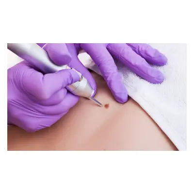 Removal of Four Moles Skin Tags Warts or Milk Spots in One Session