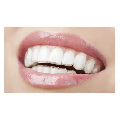 For both arches, Pure Smile clear braces