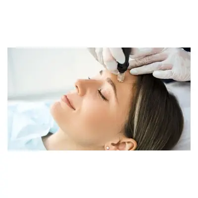 Microneedling Treatment