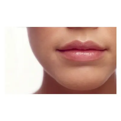 1ml Juvederm® dermal lip filler