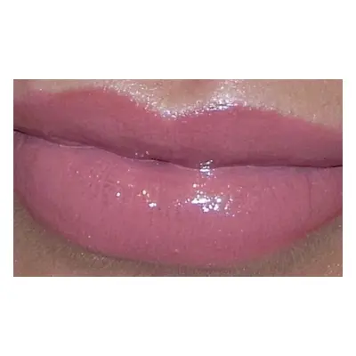 0.5 ml Dermal Filler - Lip Plump; Choice of 7 Locations