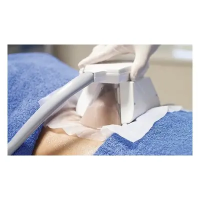 Cryogenic lipolysis under 18s must be accompanied by an adult