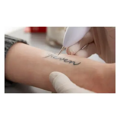 10x10cm area - 3 laser tattoo removal sessions plus consultation and patch test