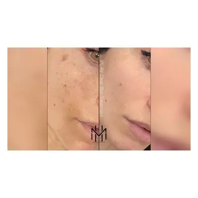 IPL-RF CLEAR-SKIN with Hydra-facial & Brightening Cleanse