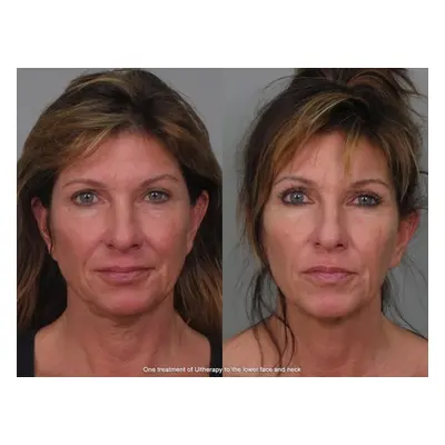 Face Contouring Non-Invasive (Full Face & Neck Lift) Radio Frequency, one sessions