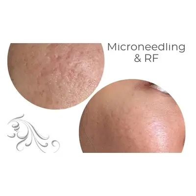 Three microneedling + Gold RF sessions