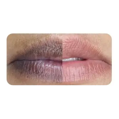 Lip Brightening (Dark Lip Neutralisation)