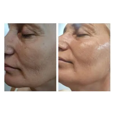 Hydra-facial with LED Light Therapy - Choose this if you don t know where to start