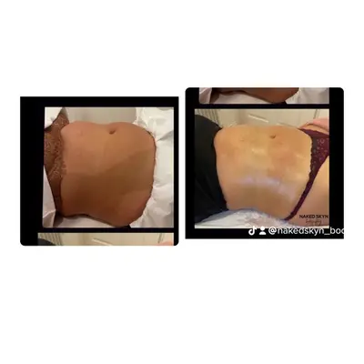 Brazilianbootylift non surgical BBL package