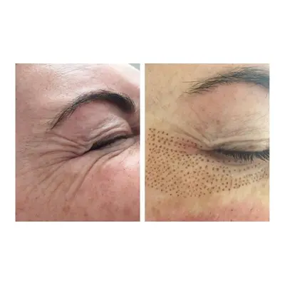 PlasmaPen eyelid tightening