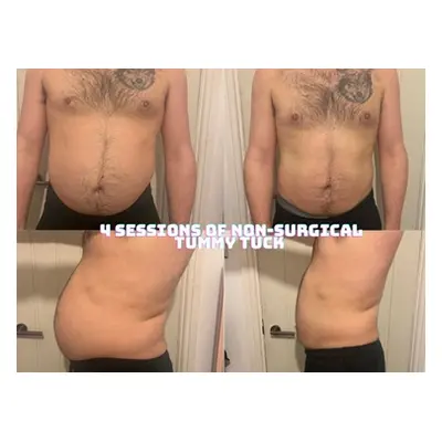 One Tummy Tuck Body Sculpting sessions that includes Ultrasonic Fat Cavitation Radio Frequency a