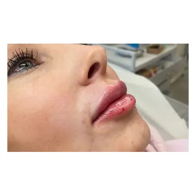 1ml cheek filler