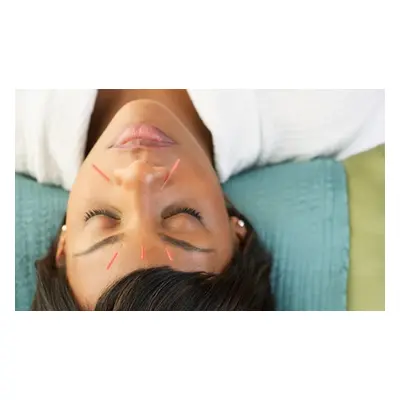 Reenergising 35-minute acupuncture session new customers only