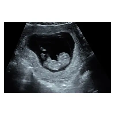 Fetal health and premium 4d scan