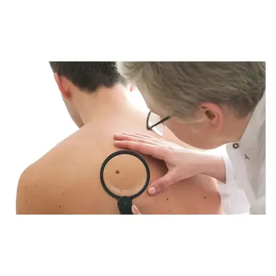 One mole wart skin tag or millia removal