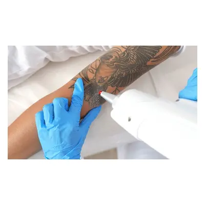 Medium area 8x8cm, three sessions of tattoo removal