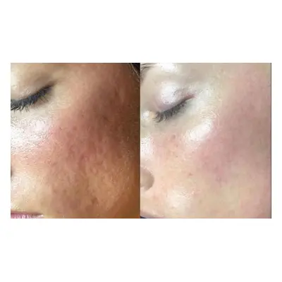 Three Sessions, Microneedling Treatment with Skin Nourishing Serum (Deluxe Package)